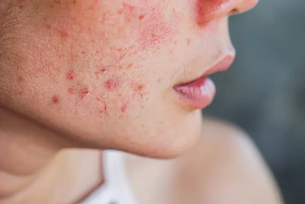 acne image 1498x