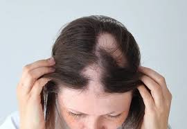 alopecia3