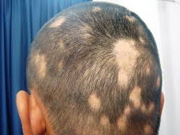 alopecia4
