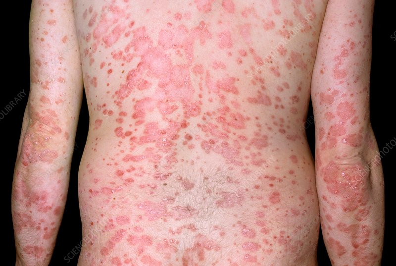 guttate psoriasis