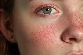 rosacea5
