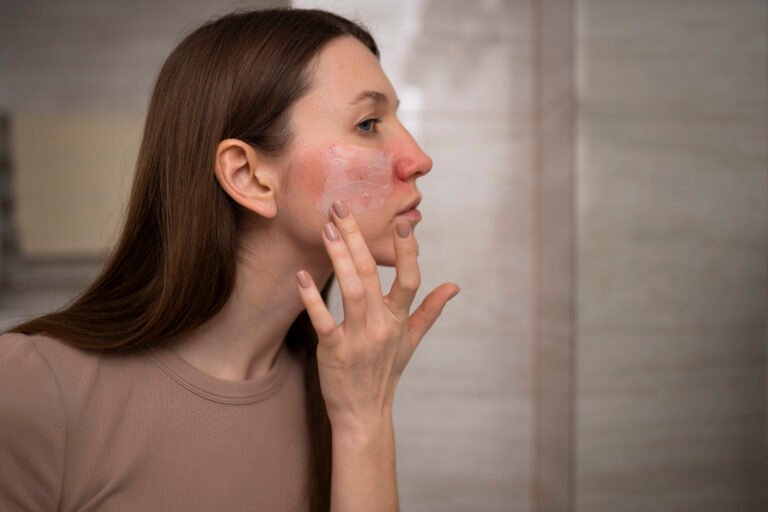 woman using moisturizer help with rosacea skin condition